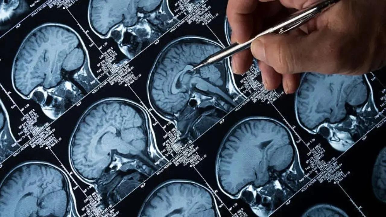 Clot-busting medicine can boost stroke patients' recovery by over 50 per cent: Study