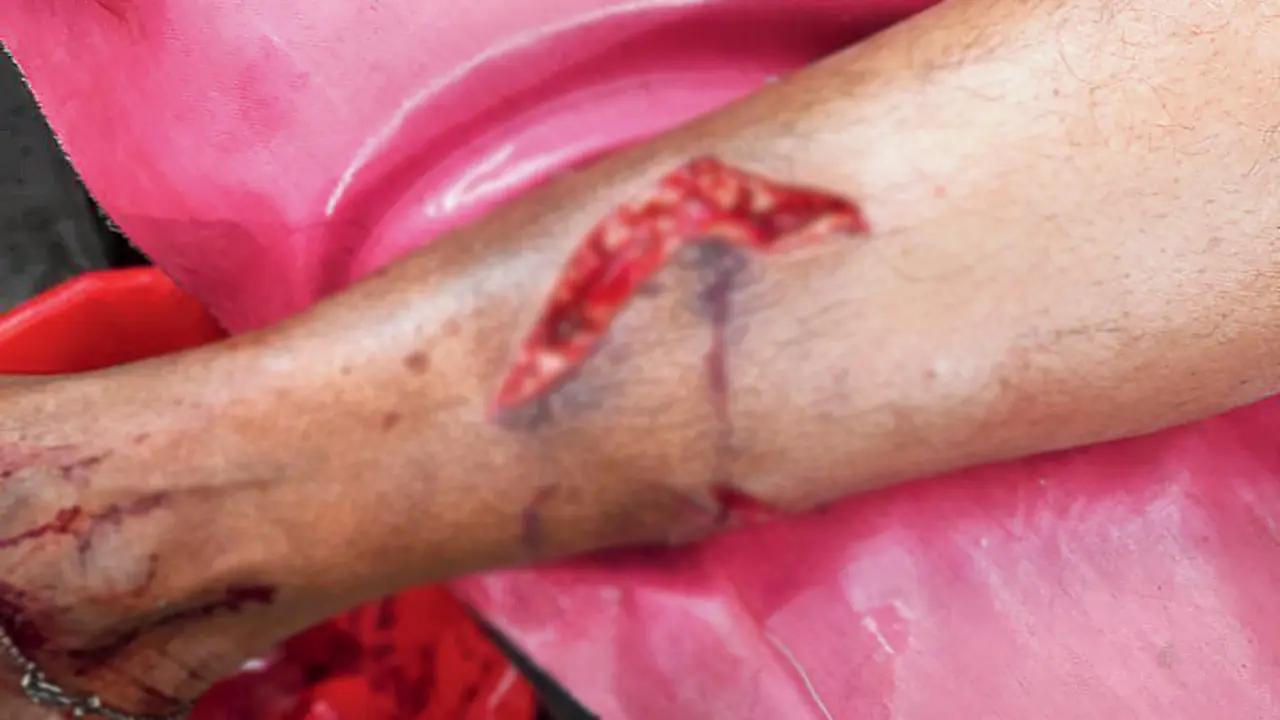 Residents of Tanaji Nagar have been facing growing concerns as stray dog attacks increase, especially targeting senior citizens and children. In 2025 alone, at least 135 people have been bitten by dogs, raising alarm in the community.