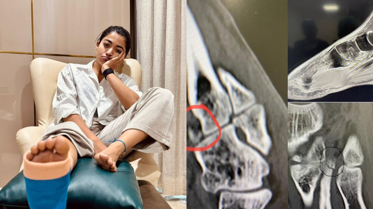 Rashmika Mandanna shows an X-ray of her injured foot with 3 fractures and a muscle tear