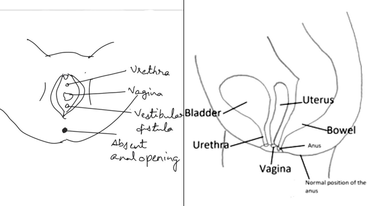 Pictorial representation in the girl’s case, (right) Pictorial representation of a normal anal opening structure