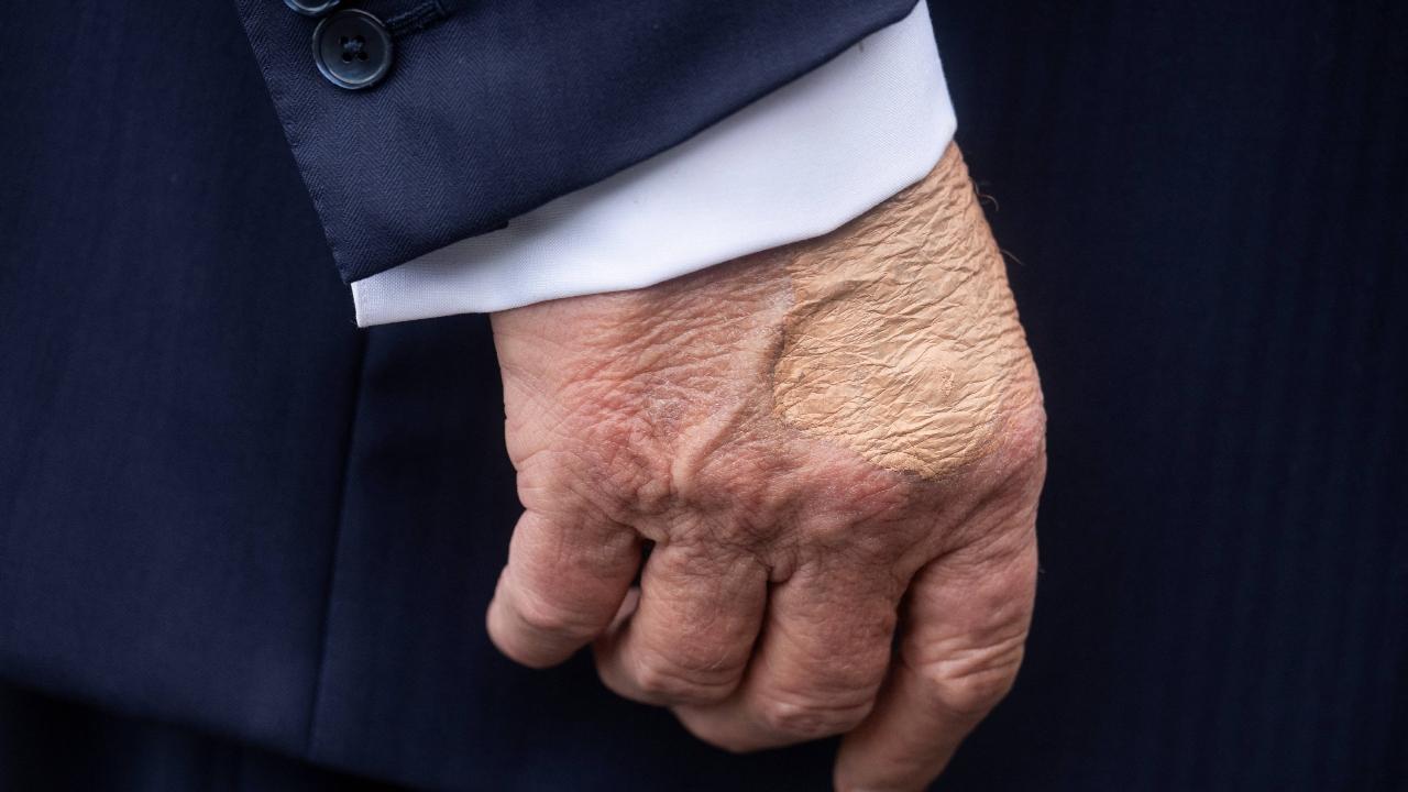 Leavitt during her weekly press briefing addressed media questions regarding the bruising on the President's hand and also swelling in his legs.