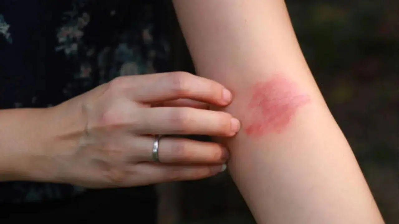Early exposure to pet dogs may lower kids' risk of eczema: Study