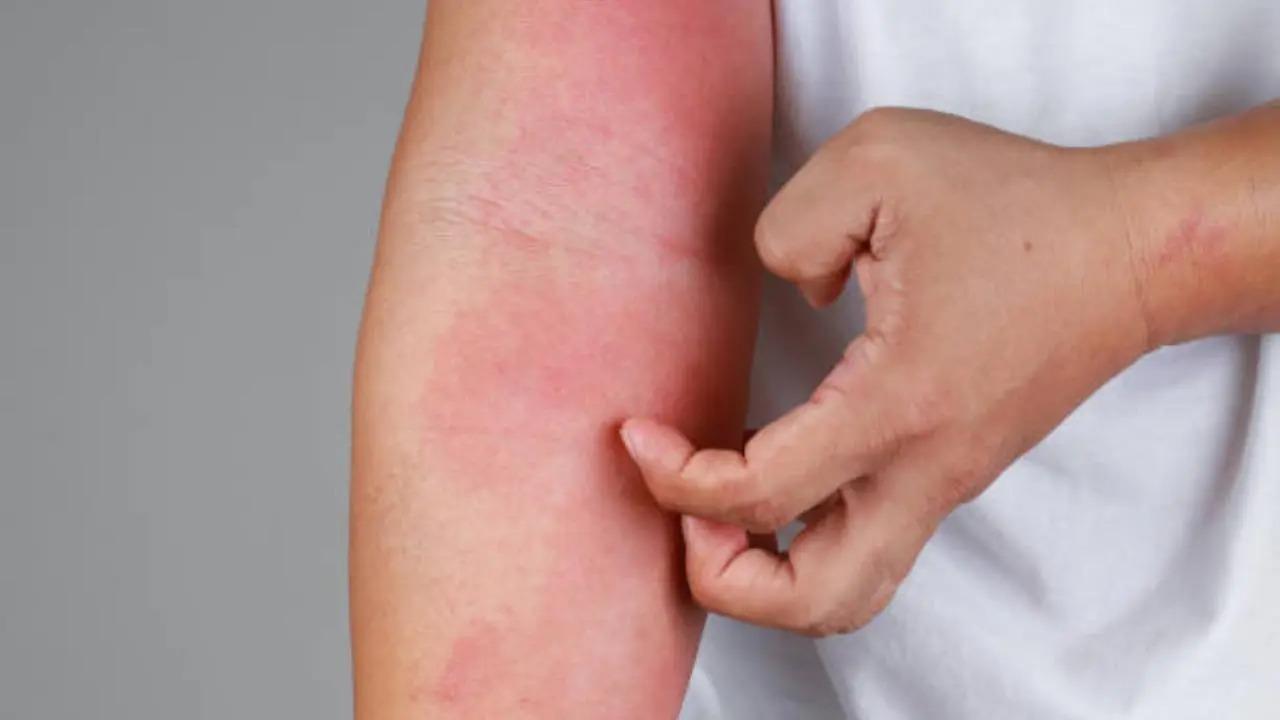 Psoriasis patients may be at risk of obesity, fatty liver disease: Study