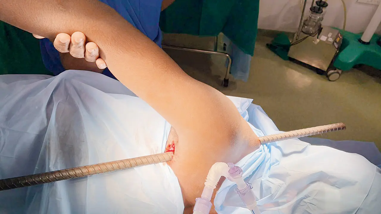 Goregaon: Construction worker survives horrific fall