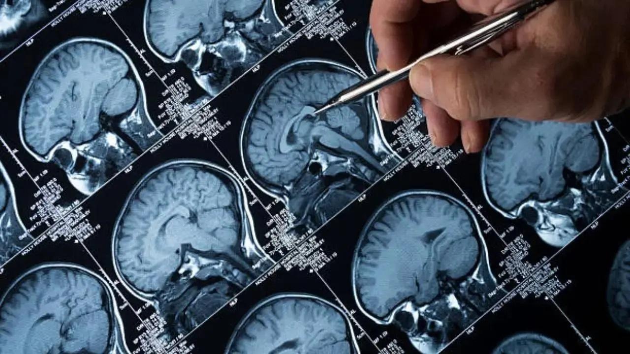 Mumbai doctor publishes study validating brain surgery to help treat Parkinson's Image for representational purpose only. Photo Courtesy: File pic