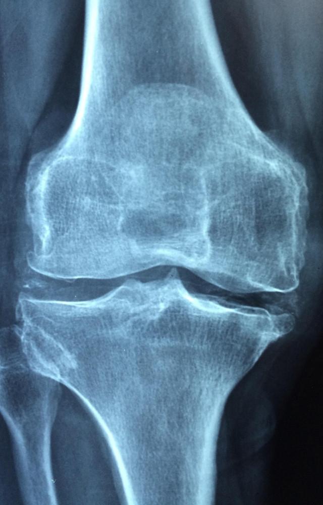 Rheumatoid Arthritis Awareness Day: Know 5 important facts