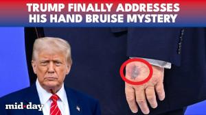 Accident or health? Trump explains ‘suspicious bruise’ on hand after Davos event