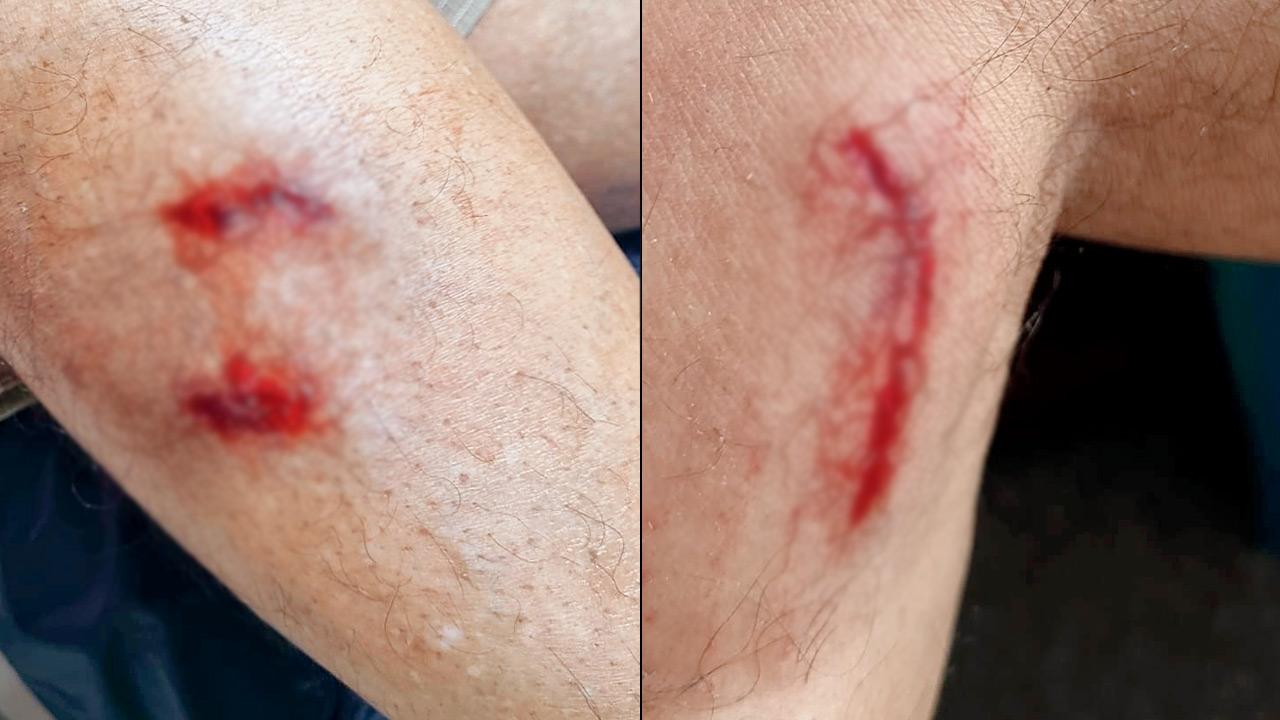 Residents show bite marks from an alleged stray dog attack outside the Viceroy Park housing complex in Kandivli East. Pics/By Special Arrangement