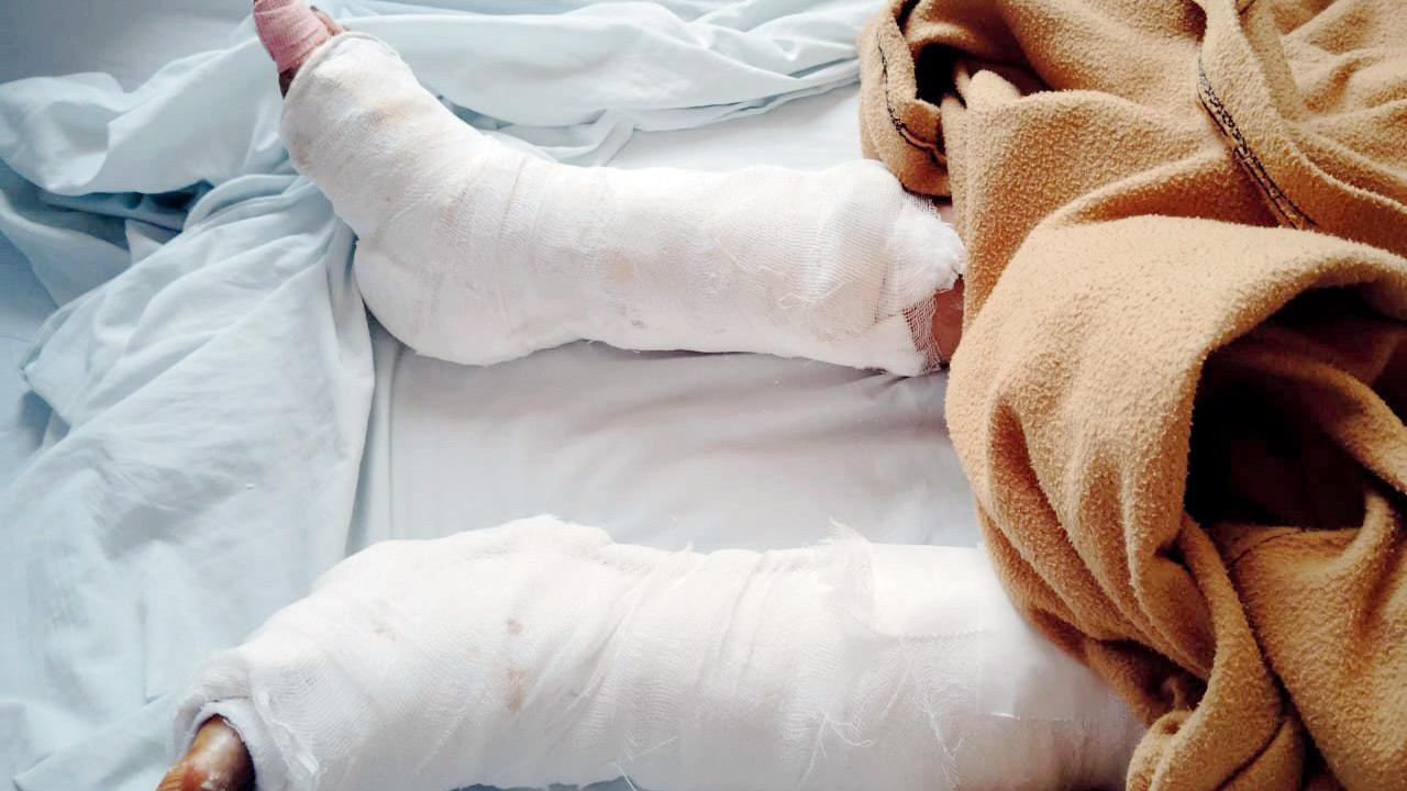 Injuries sustained by Bandra West resident Shobha Tendulkar after falling in hole at eastern end of Hill Road. PIC/By Special Arrangement