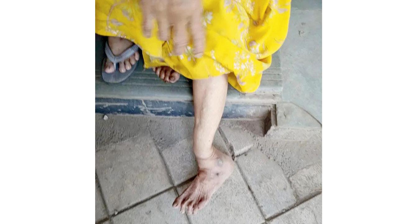 Shobha Tendulkar’s injuries. PIC/By Special Arrangement