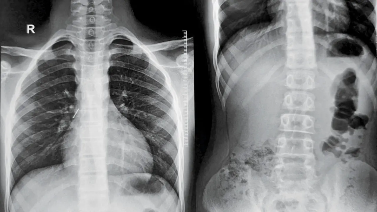 Mumbai doctors remove pushpin stuck near boy’s lungs in delicate surgery