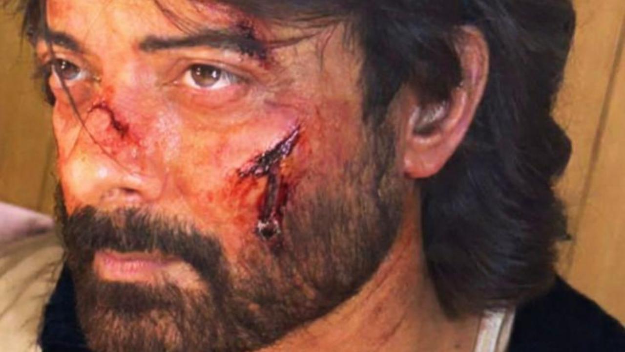 A bloody and bruised Rahul Bhat shoots for his next Netflix project