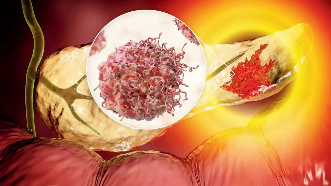 REDMOD can detect extremely early signs of pancreatic cancer. PIC COURTESY/MAYO CLINIC