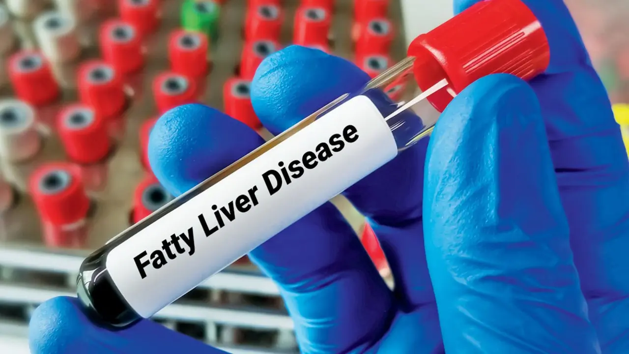 UBE2N enzyme may help protect liver from fatty liver disease, study finds Representational pic/iStock