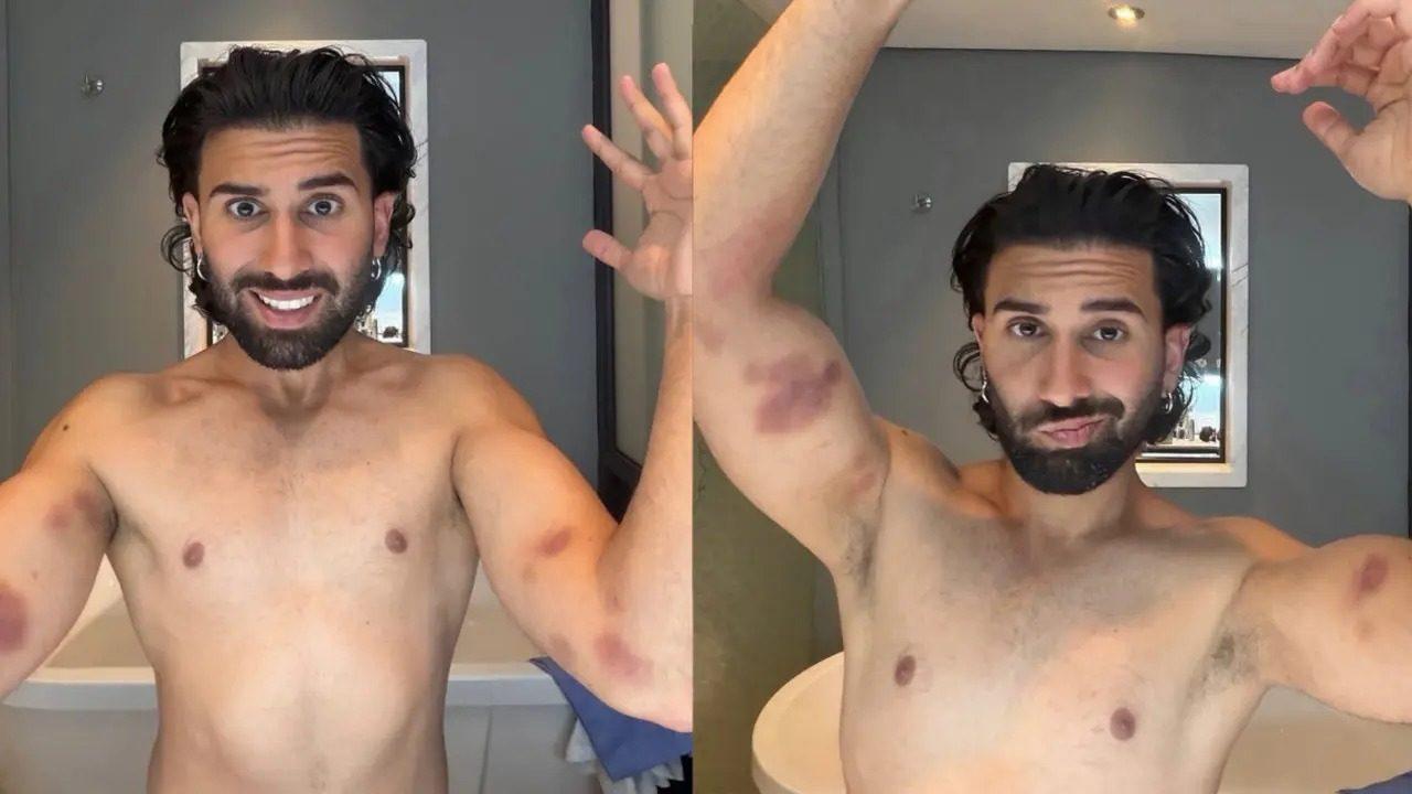 Orry's latest stunt on Khatron Ke Khiladi 15 left him with painful bruises, leaving fans concerned about his safety. The stunt-based reality show, hosted by Rohit Shetty, is heading towards its much-awaited finale, with the winner set to be announced by Saturday-Sunday. Read more
