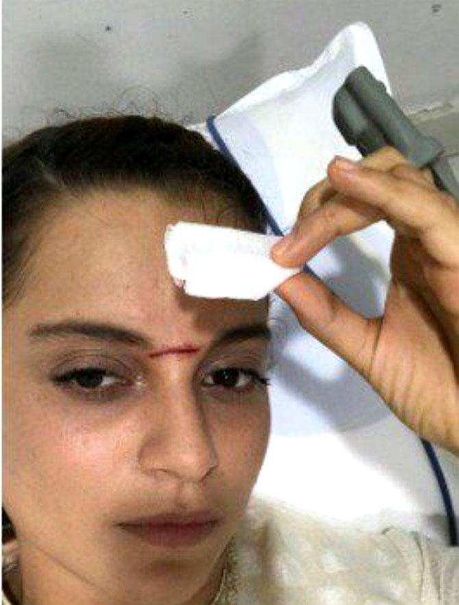 The shoot of `Manikarnika - The Queen Of Jhansi` turned into a bloodbath after the actor was severely injured. Kangana Ranaut got hit on her head by a sword while shooting. When we spoke to Kangana about the injury, she said, `I am a bit embarrassed to be thrilled to have a battle scar on my face. Also, people from my team have been telling me that it`s like that Peshwa teeka that Manikarnika wore. It`s a bit dramatic but I am excited that my face was covered in blood and I got a genuine and authentic glimpse of the Queen`s life.` She got 15 stitches on her forehead and was hospitalised for a week. The shoot of `Manikarnika - The Queen Of Jhansi` turned into a bloodbath after the actor was severely injured. Kangana Ranaut got hit on her head by a sword while shooting. When we spoke to Kangana about the injury, she said, `I am a bit embarrassed to be thrilled to have a battle scar on my face. Also, people from my team have been telling me that it`s like that Peshwa teeka that Manikarnika wore. It`s a bit dramatic but I am excited that my face was covered in blood and I got a genuine and authentic glimpse of the Queen`s life.` She got 15 stitches on her forehead and was hospitalised for a week.