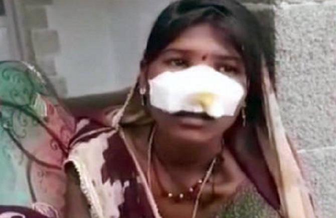 Woman's nose cut off: The nose of a woman was allegedly slit off in Madhya Pradesh's Sagar district by two people as she, along with her husband, refused to work as bonded labourers. After the accused allegedly beat him for denying doing household and fieldwork, the woman was taking her husband to the hospital for treatment. It was then that the attackers caught hold of them and cut off the woman's nose. The woman was immediately admitted to the Bundelkhand Medical College and was in a critical condition and the cops said that strict action will be taken against the accused. The incident happened in 2017.