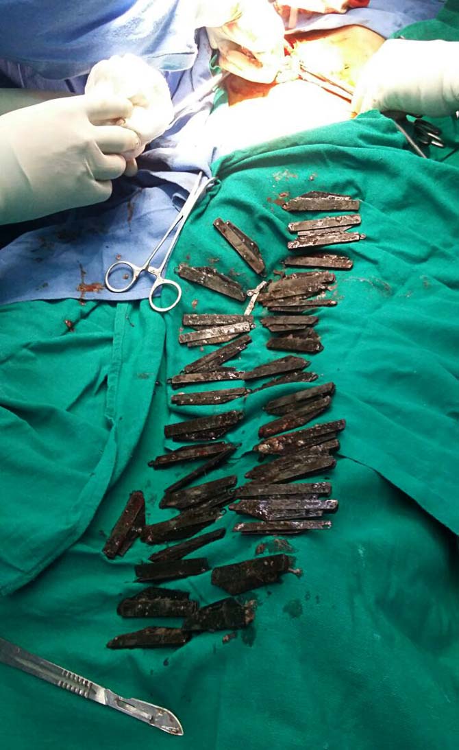 In an unusual case, as many as 40 knives were surgically removed from the stomach of a policeman who claimed that he used to feel an 'urge' to eat them. A team of five doctors carried out a five-hour-long surgery on Surjeet Singh, who was then employed with the Punjab Police